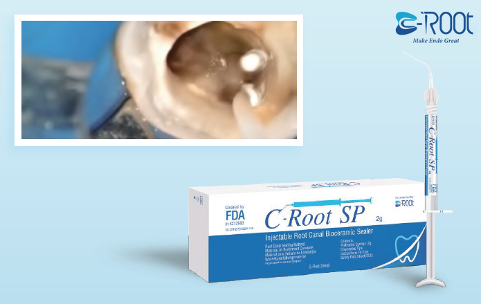 C-Root SP - силер для постійної обтурації DS-3914 фото